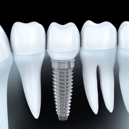 dental-imolants